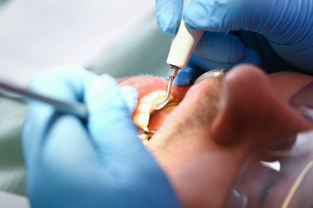 Best Emergency Wisdom Teeth Removal in Elizabethville, PA